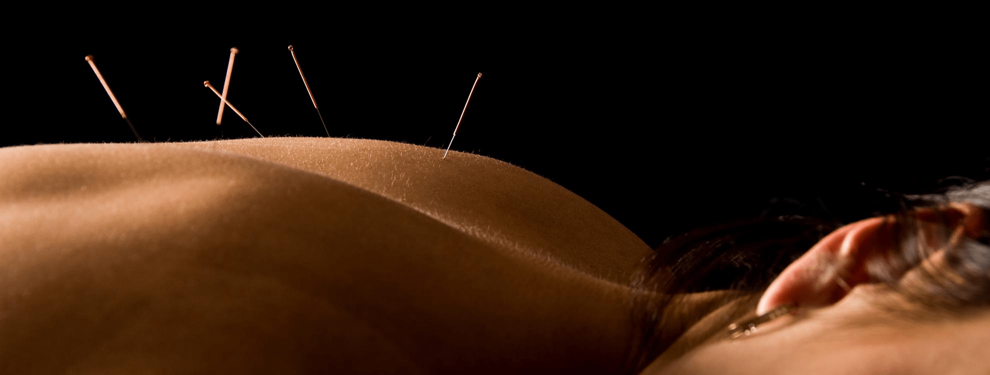 femme durant une séance d'acupuncture